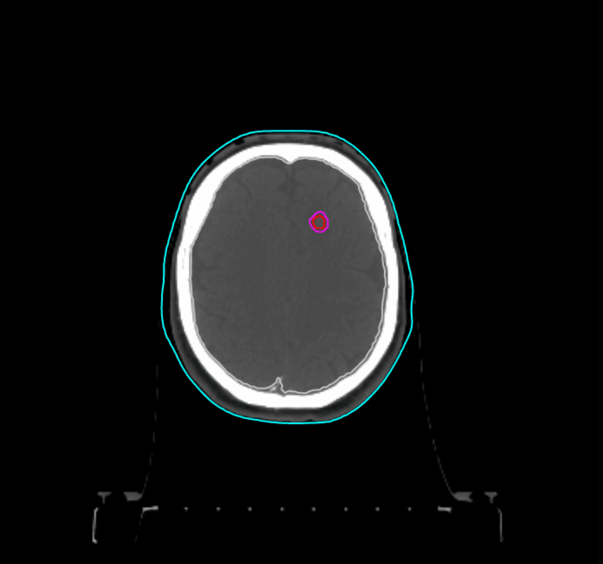 Beyinde yapılan bir SRS tekniği örneği.
